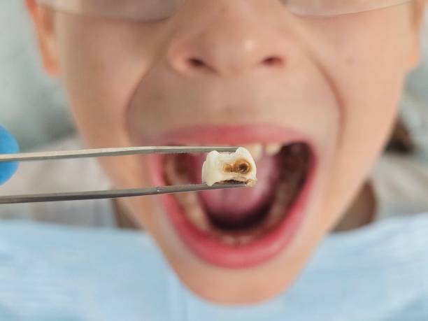 Best Emergency Root Canal Treatment in Whitehall, WI