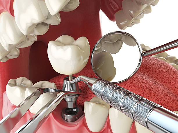 Best Emergency Tooth Extraction in Whitehall, WI